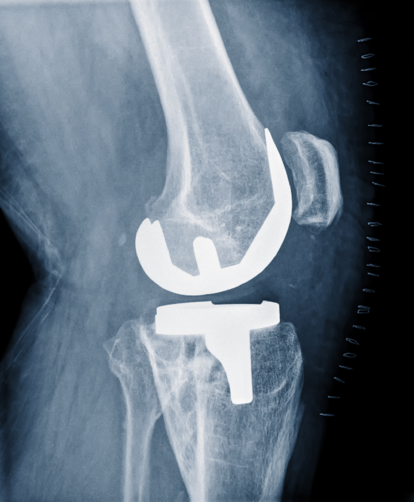 Knee Replacement