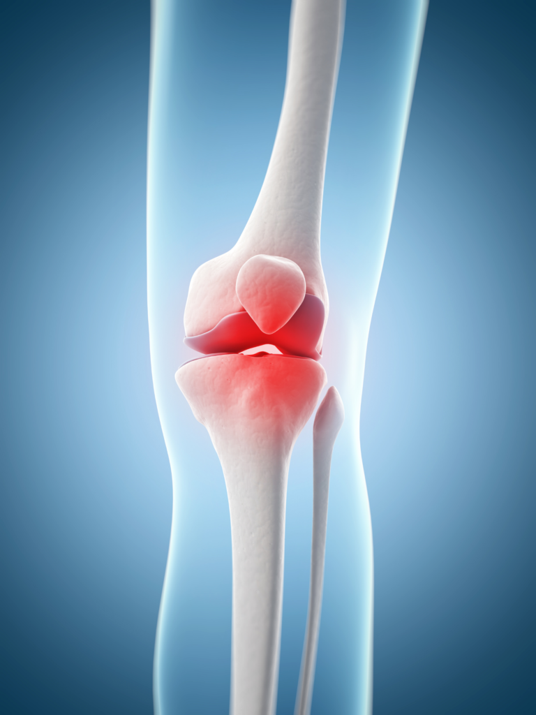 Knee Cartilage (Meniscus) Tear